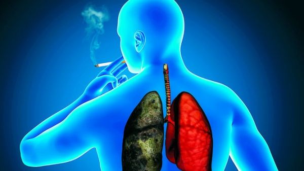 Nuevo tratamiento curativo para cáncer de pulmón