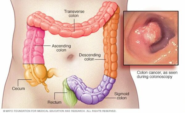 El estilo de vida saludable evita el desarrollo del cáncer de colon