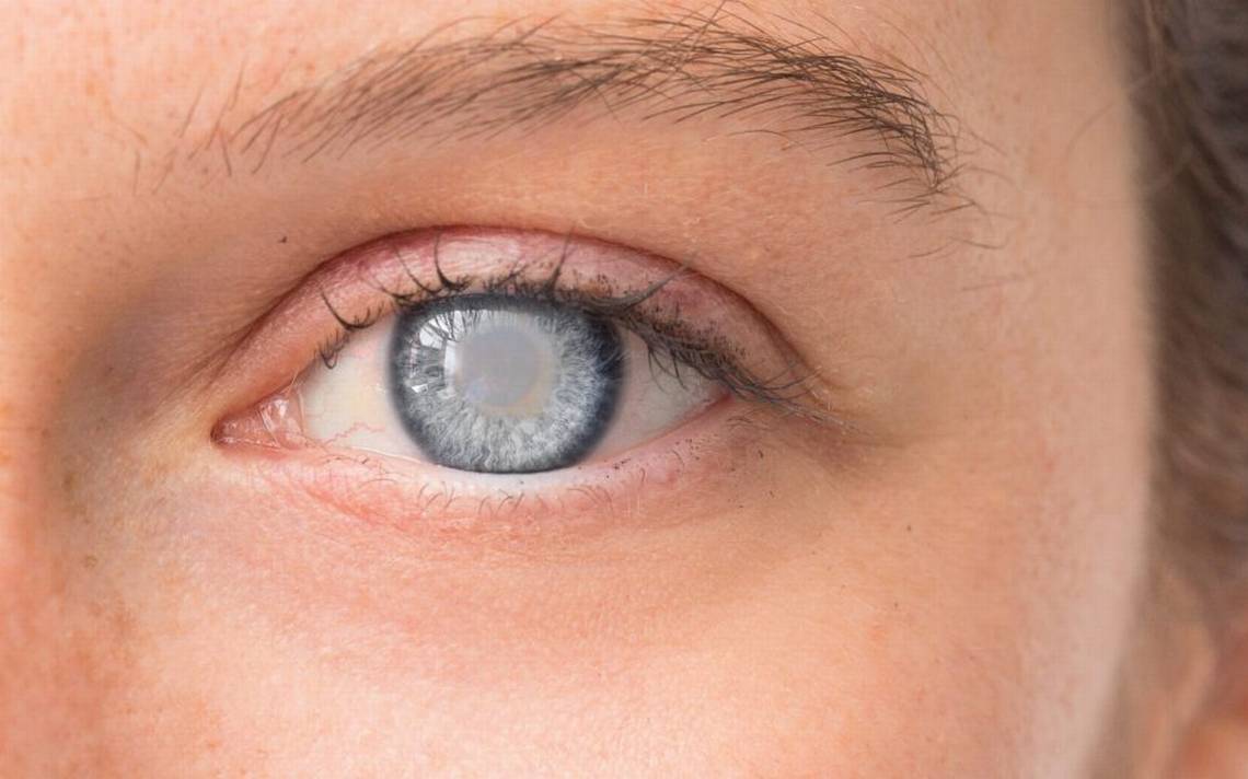 El glaucoma, mal silencioso que causa discapacidad visual y ceguera