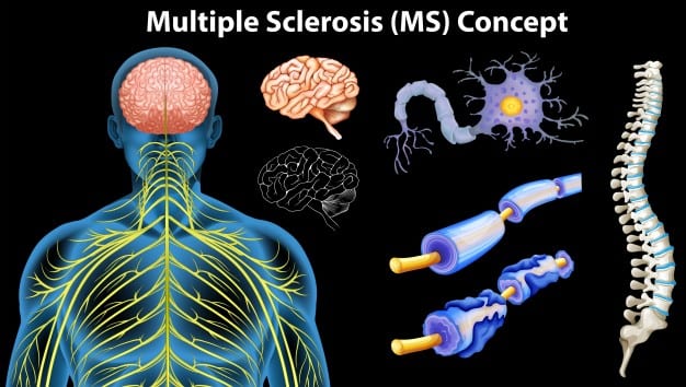 El diagnóstico oportuno vital en el paciente con esclerosis múltiple