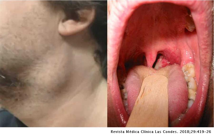 El diagnóstico oportuno reduce la mortalidad por cáncer de cabeza y cuello