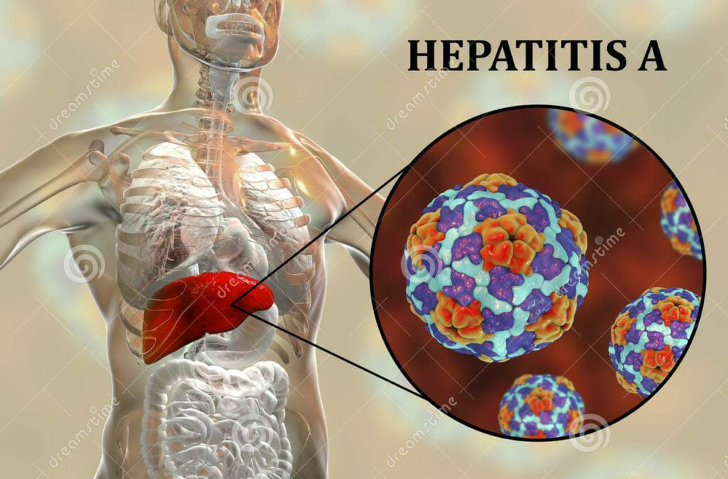 La hepatitis A se puede prevenir con higiene