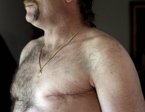 El cáncer de mama es raro en varones, pero resulta más agresivo