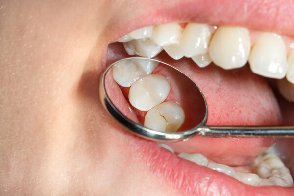 La caries, uno de los padecimientos más comunes en los yucatecos